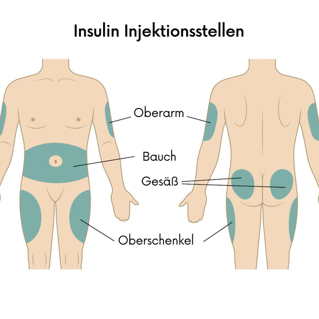 Die besten Insulin Injektionsstellen 